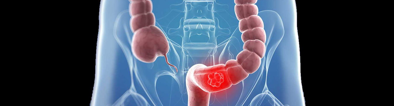 Best Colorectal Surgeon in Bangalore Best Colorectal